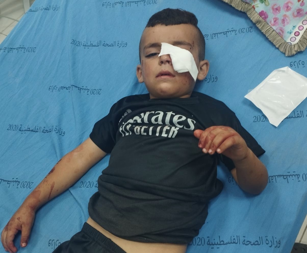 الخليل : إصابة طفل بحروق في هجوم للمستوطنين على مسافر يطا