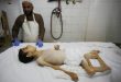 استشهاد طفل نتيجة التجويع في قطاع غزة