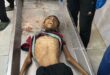 وفاة طفلين بسبب سوء التغذية والمجاعة في قطاع غزة
