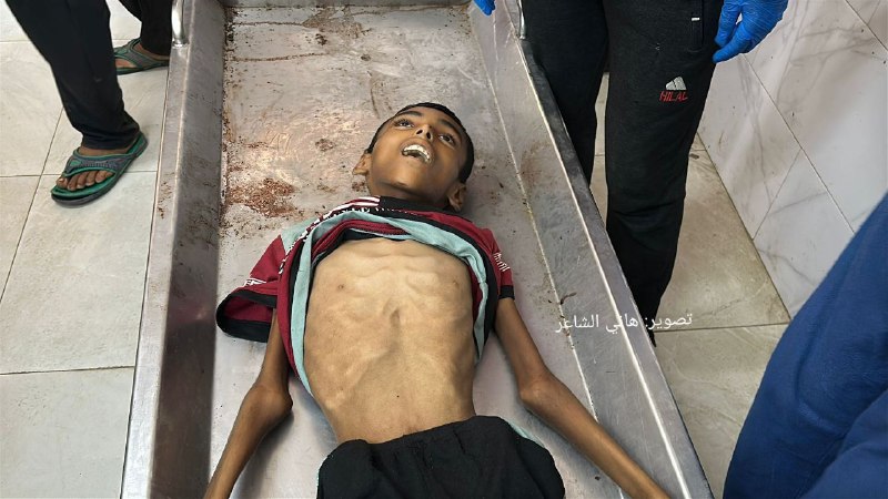 وفاة طفلين بسبب سوء التغذية والمجاعة في قطاع غزة