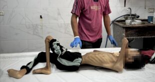 وفاة 10 أشخاص بسبب المجاعة وسوء التغذية في قطاع غزة