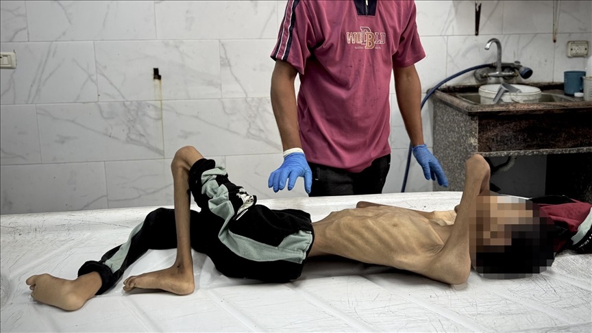 وفاة 10 أشخاص بسبب المجاعة وسوء التغذية في قطاع غزة