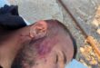 إصابة الشاب أحمد الهذالين جراء اعتداء المستوطنين عليه بمسافر يطا جنوب الخليل
