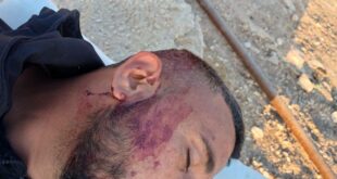 إصابة الشاب أحمد الهذالين جراء اعتداء المستوطنين عليه بمسافر يطا جنوب الخليل