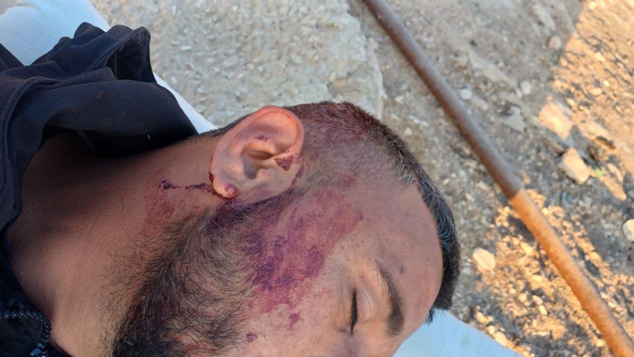 إصابة الشاب أحمد الهذالين جراء اعتداء المستوطنين عليه بمسافر يطا جنوب الخليل