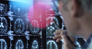 دواء زهايمر يحقق نتائج مذهلة في تأخير المرض 8 سنوات