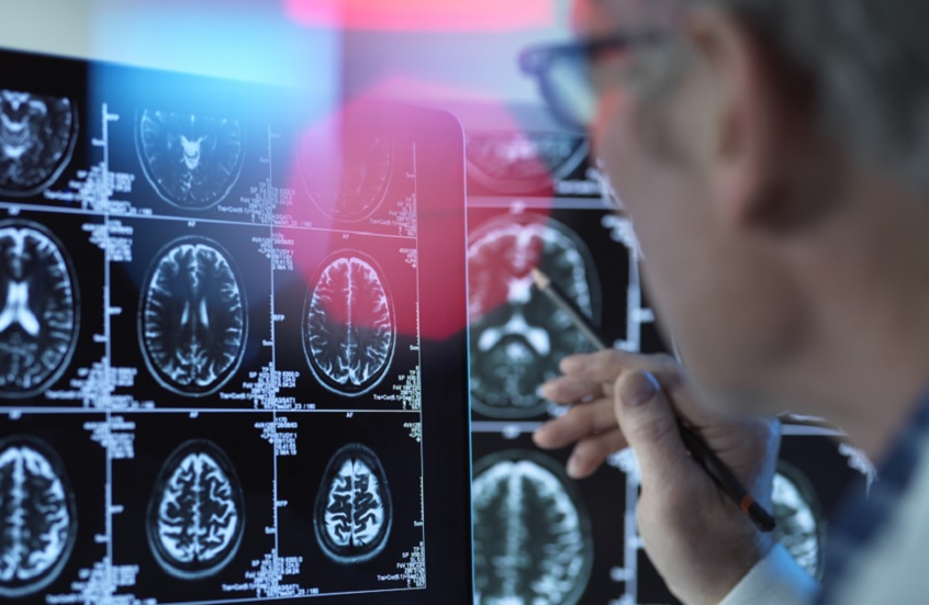 دواء زهايمر يحقق نتائج مذهلة في تأخير المرض 8 سنوات