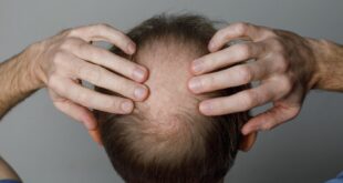 أمل جديد للرجال.. علاج ثوري يظهر نتائج مذهلة في استعادة الشعر المفقود